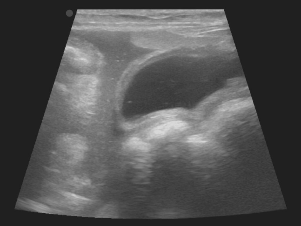 Canine Anaphylactic Medically Treated Hemoabdomen - A Unique Canine Complication Every Veterinarian Should Know